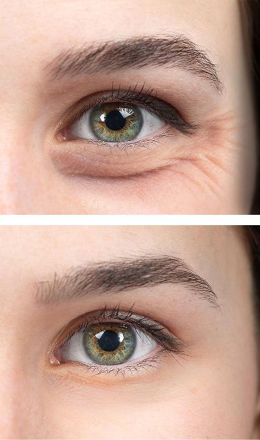 Reduce Crows feet with our Aesthetic treatments in Berkshire, before and after shots